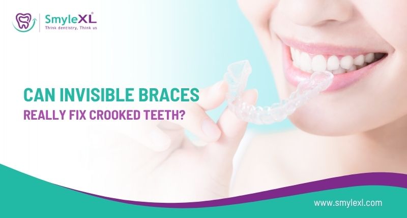 Can Invisible Braces Really Fix Crooked Teeth?