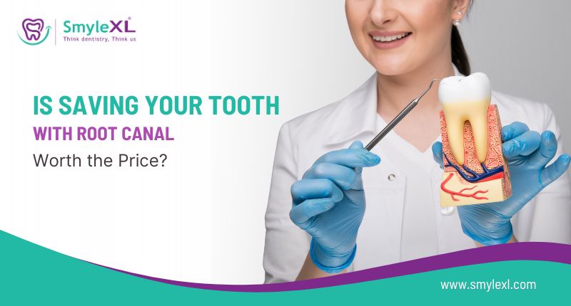 Is Saving Your Tooth with a Root Canal Worth the Price?