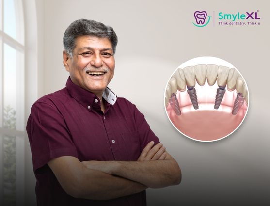 full mouth restoration in vijay nagar indore