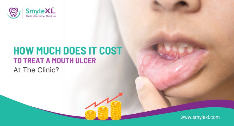 How Much Does It Cost to Treat a Mouth Ulcer at the Clinic?