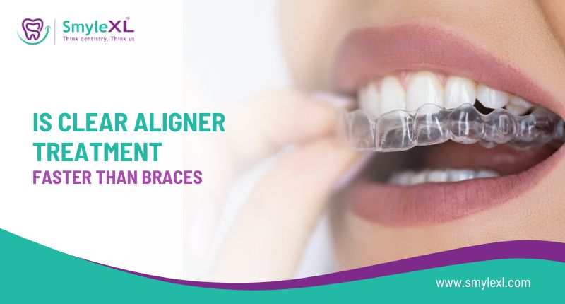Is Clear Aligner Treatment Faster Than Braces?