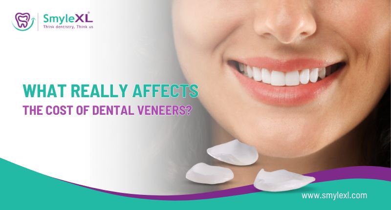 What Really Affects the Cost of Dental Veneers?