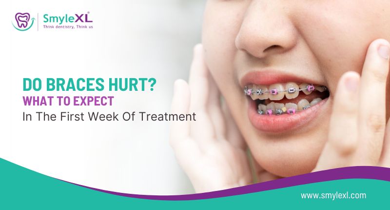 Do Braces Hurt? What to Expect in the First Week of Treatment