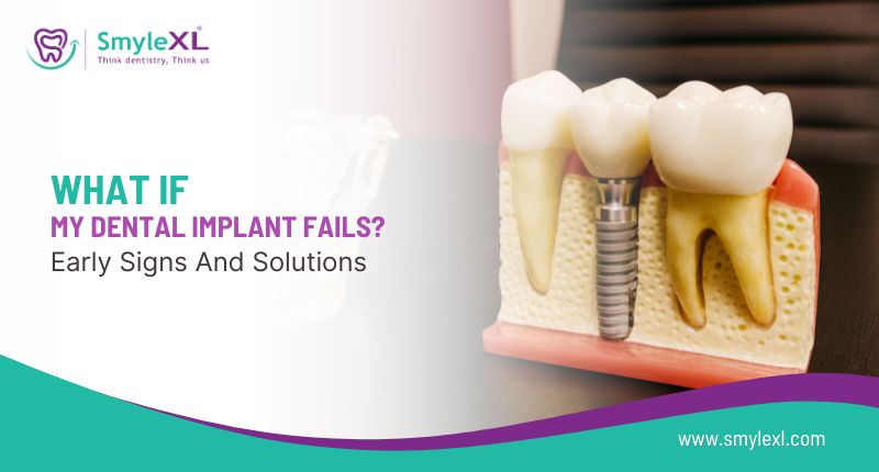 What If My Dental Implant Fails? Early Signs and Solutions