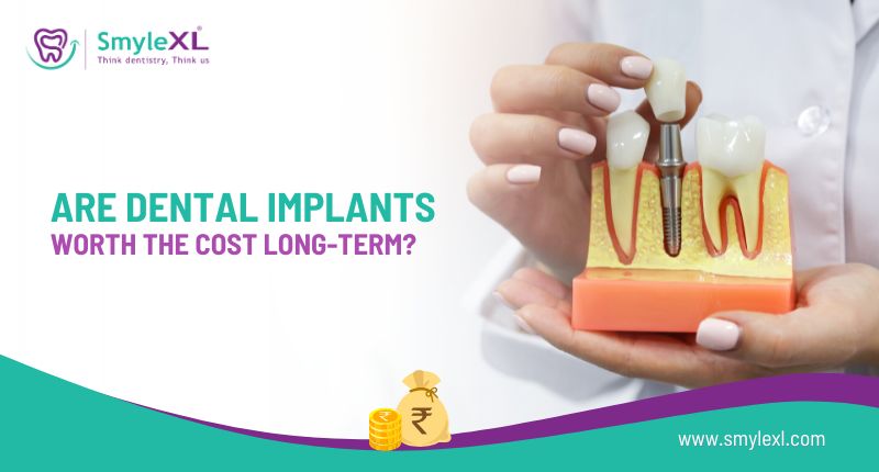 Are Dental Implants Worth the Cost Long-Term?