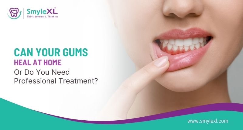 Can Your Gums Heal at Home or Do You Need Professional Treatment?