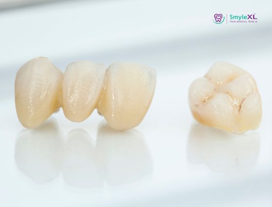 Crown and Bridge Treatment in Ashiyana Lucknow