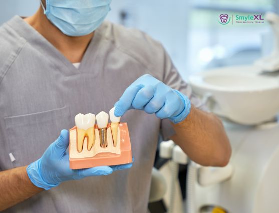 Dental Implant Treatment in Ashiyana Lucknow