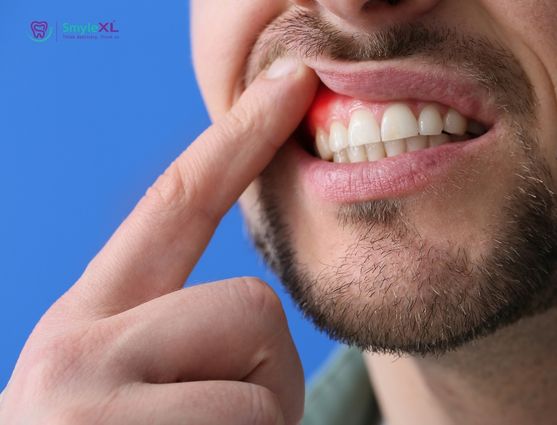 Gum Treatment in Ashiyana Lucknow