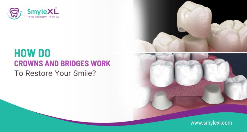 How Do Crowns and Bridges Work to Restore Your Smile?
