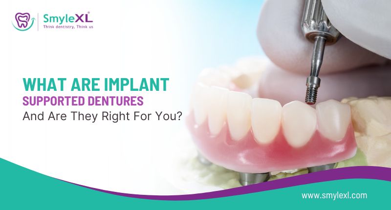 What Are Implant-Supported Dentures and Are They Right for You?