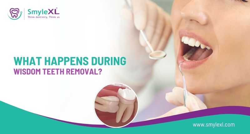 WHAT HAPPENS DURING WISDOM TEETH REMOVAL?