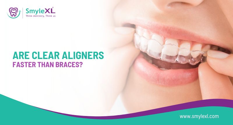 Are Clear Aligners Faster Than Braces?