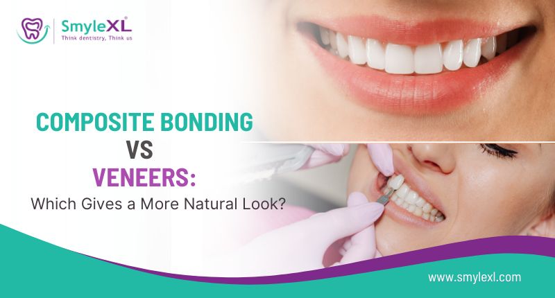 Composite Bonding vs. Veneers: Which Gives a More Natural Look?