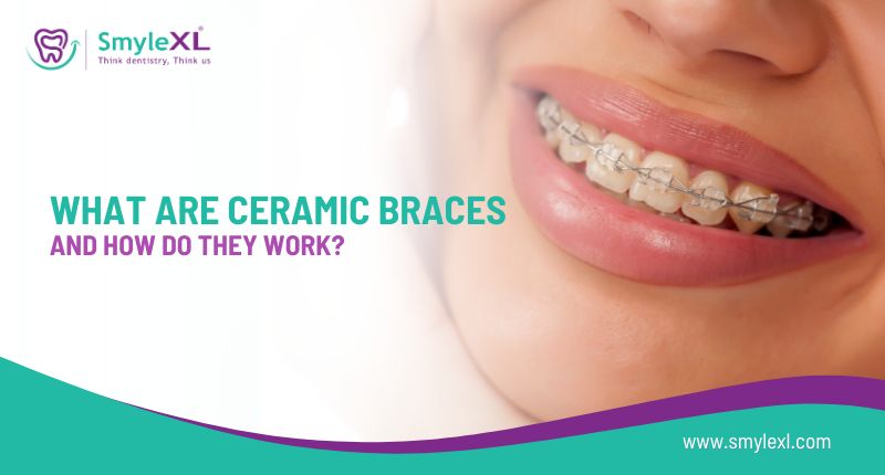 What Are Ceramic Braces and How Do They Work?