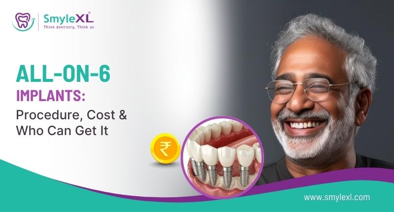 All-on-6 Implants: Procedure, Cost & Who Can Get It