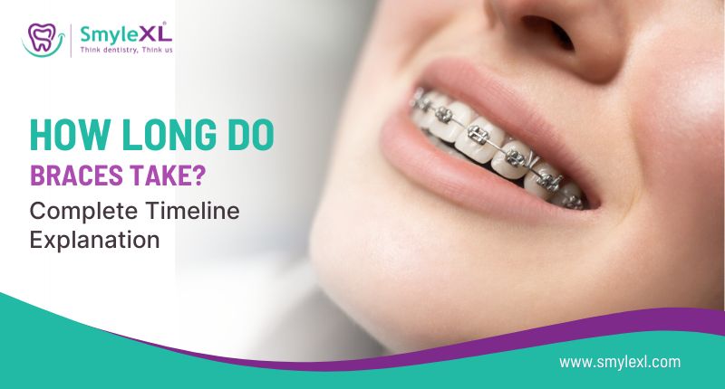 How Long Do Braces Take? Complete Timeline Explanation