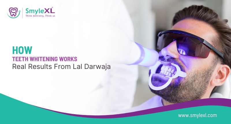 How Teeth Whitening Works – Real Results from Lal Darwaja