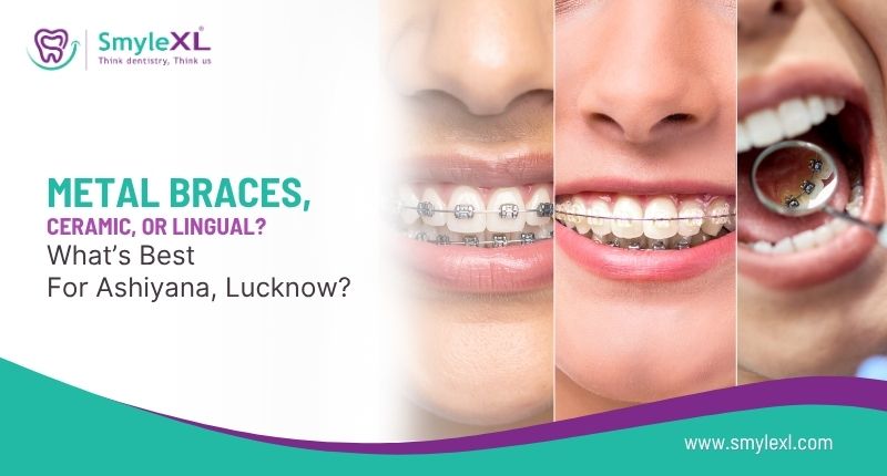 Metal Braces, Ceramic, or Lingual? What’s Best for Ashiyana, Lucknow?