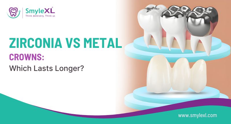 Zirconia vs Metal Crowns: Which Lasts Longer?
