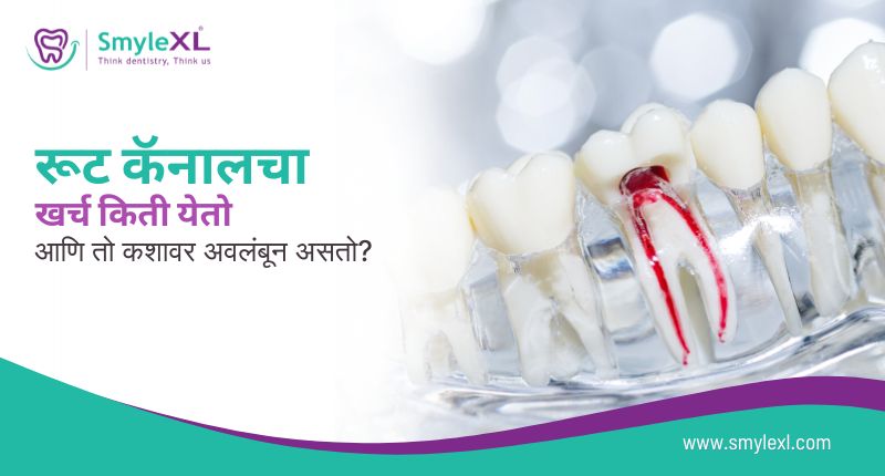 रूट कॅनालचा खर्च किती येतो आणि तो कशावर अवलंबून असतो?