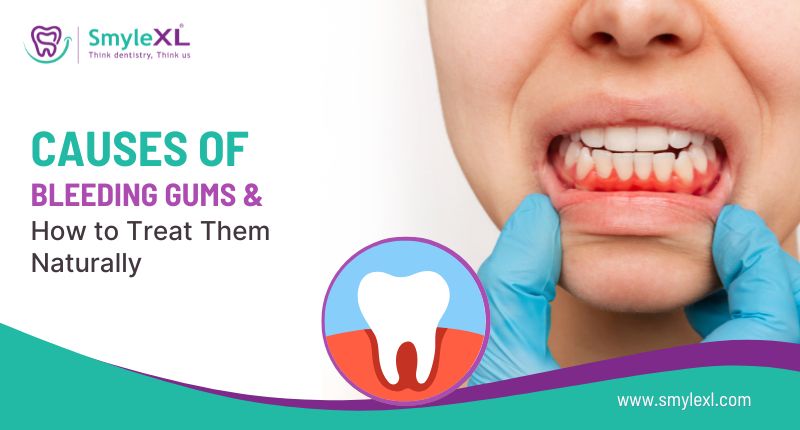 Causes of Bleeding Gums & How to Treat Them Naturally
