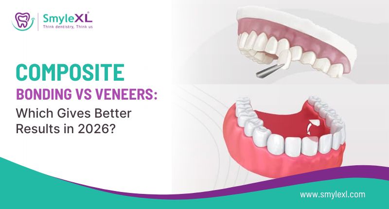 Composite Bonding vs Veneers: Which Gives Better Results in 2026?