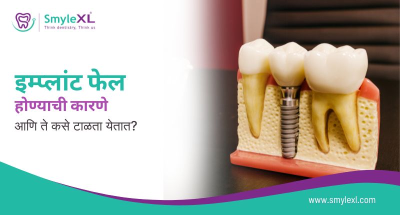 इम्प्लांट फेल होण्याची कारणे आणि ते कसे टाळता येतात?