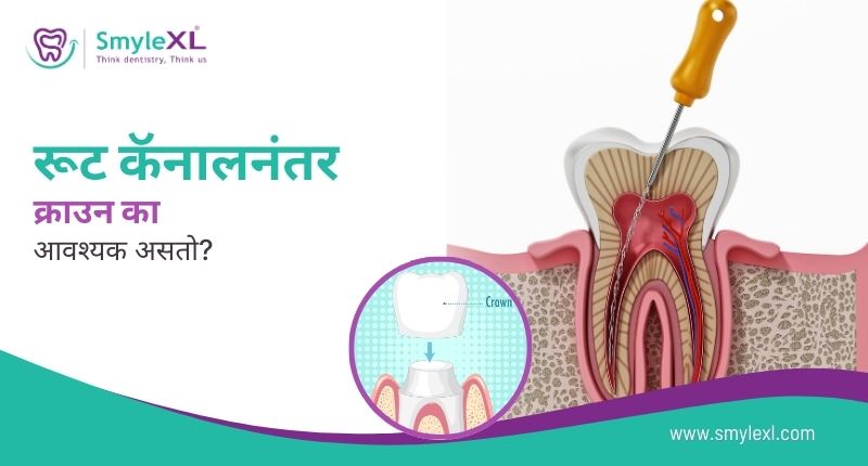रूट कॅनालनंतर क्राउन का आवश्यक असतो?