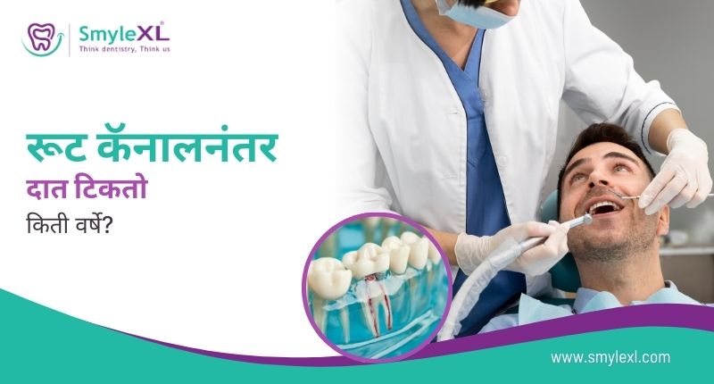 रूट कॅनालनंतर दात टिकतो किती वर्षे?