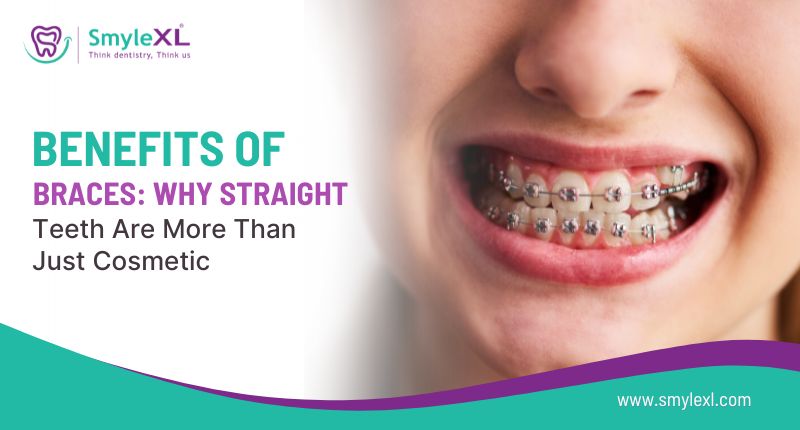 Benefits of Braces: Why Straight Teeth Are More Than Just Cosmetic