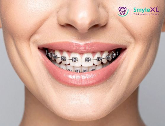 Braces Treatment in Chitradurga