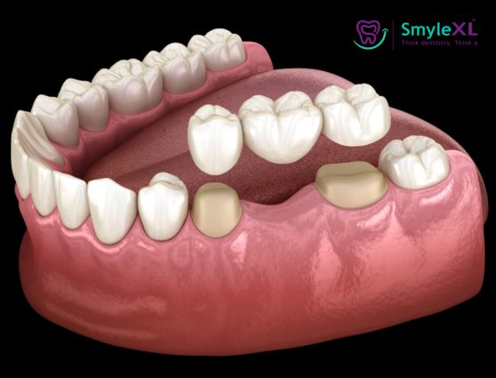 Crown and Bridge Treatment in Chitradurga