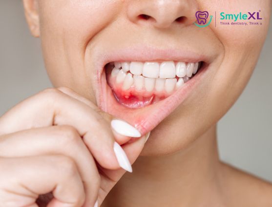 Mouth Ulcers in Chitradurga