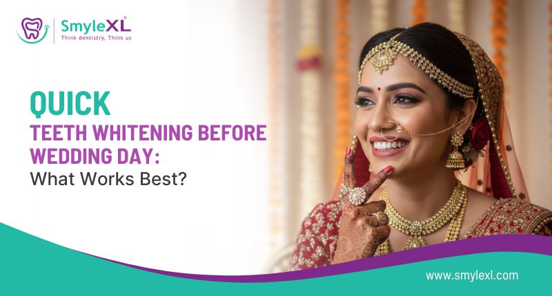 Quick Teeth Whitening Before Wedding Day: What Works Best?