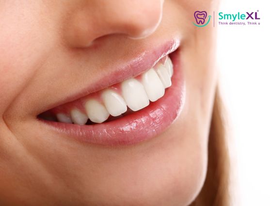Smile Makeover Treatment in Chitradurga