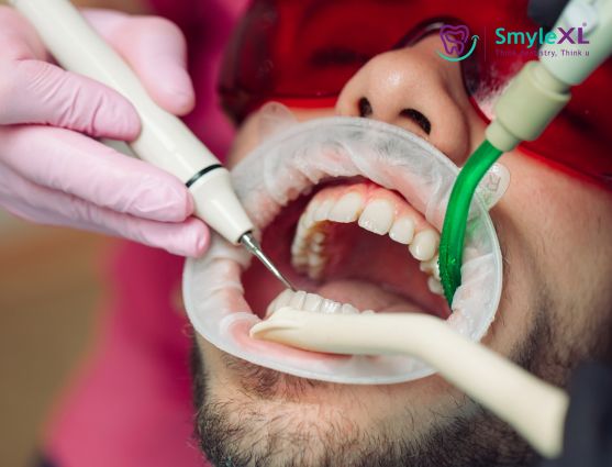 Teeth Cleaning Treatment in Chitradurga