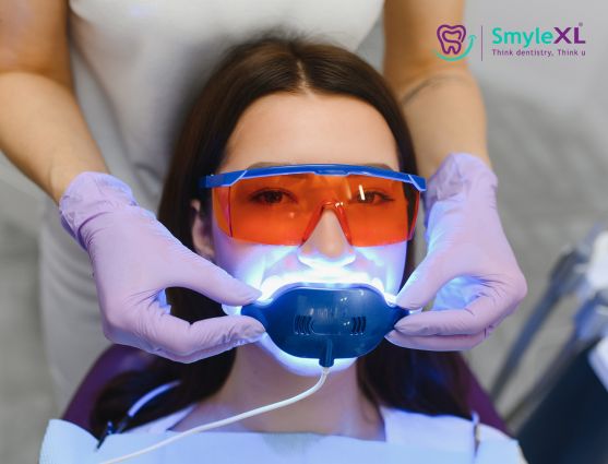 Teeth Whitening in Chitradurga