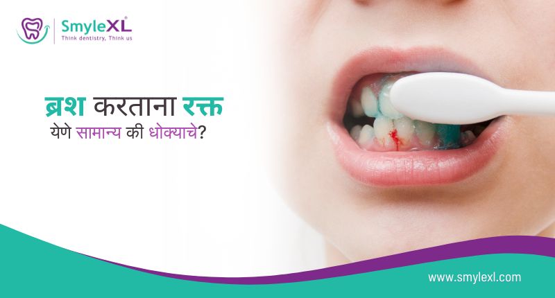 ब्रश करताना रक्त येणे सामान्य की धोक्याचे?