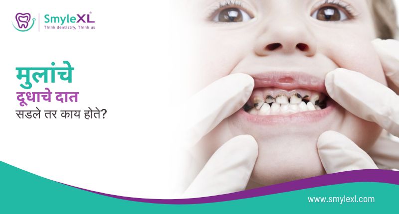 मुलांचे दूधाचे दात सडले तर काय होते?