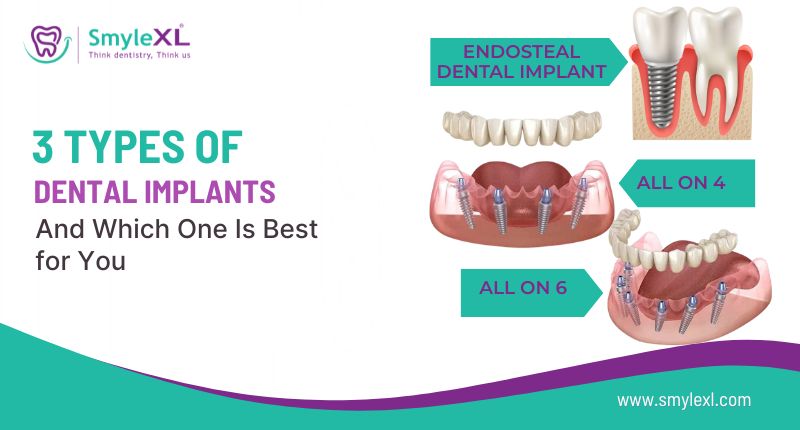 3 Types of Dental Implants and Which One Is Best for You