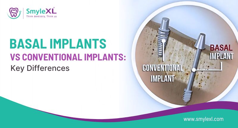 Basal Implants vs Conventional Implants: Key Differences