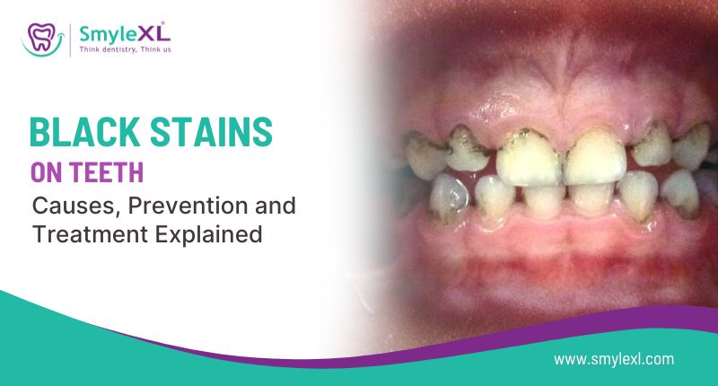 Black Stains on Teeth: Causes, Prevention, and Treatment Explained