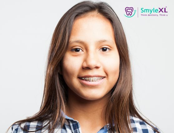 Braces Treatment in Kalyan West