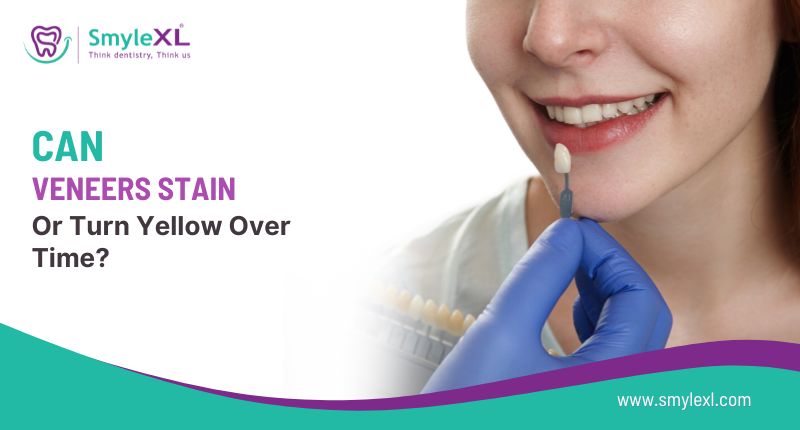 Can Veneers Stain or Turn Yellow Over Time?