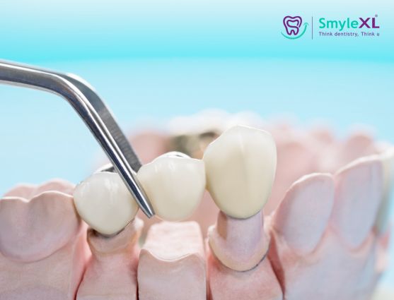 Crown and Bridge Treatment in Kalyan West