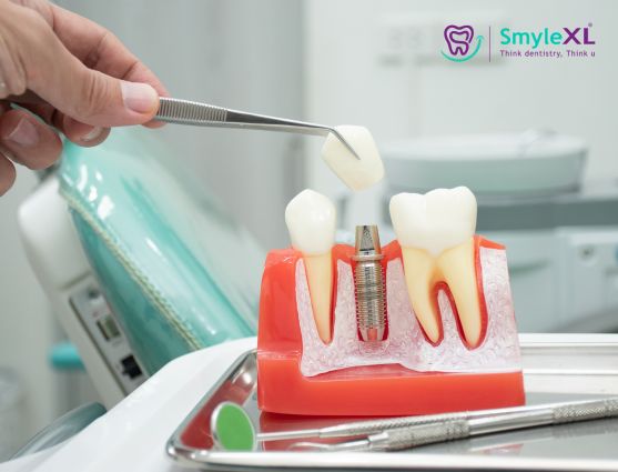 Dental Implant Treatment in Kalyan West
