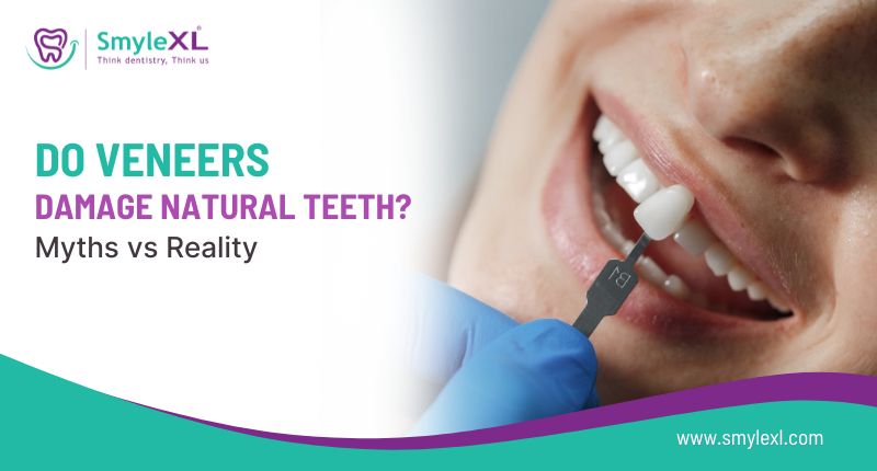 Do Veneers Damage Natural Teeth? Myths vs Reality