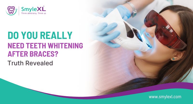 Do You Really Need Teeth Whitening After Braces? Truth Revealed
