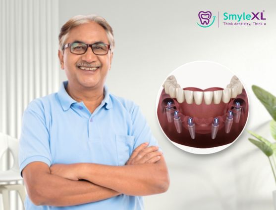 Full Mouth Restoration in Kalyan West